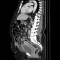 Acute pyelonephritis (Radiopaedia 25657-25837 Sagittal renal parenchymal phase 45).jpg