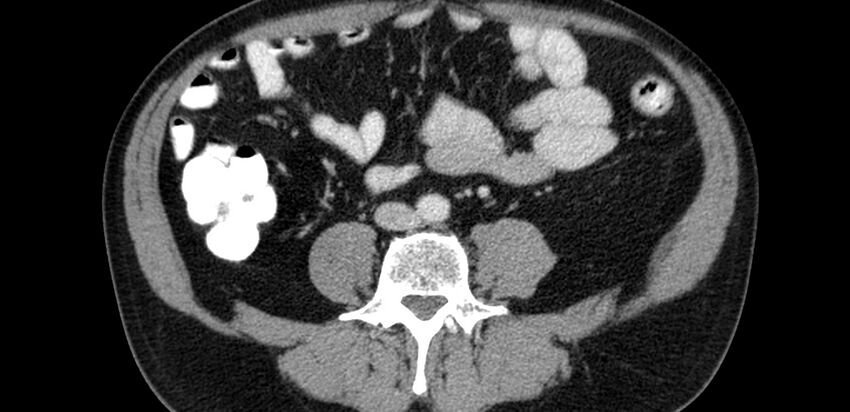 Acute sigmoid colon diverticulitis (Radiopaedia 55507-61976 Axial C+ portal venous phase 42).jpg