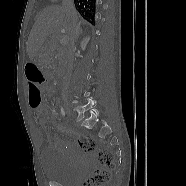 File:Acute vertebral body compression fractures (Radiopaedia 31757-32693 Sagittal bone window 38).jpg