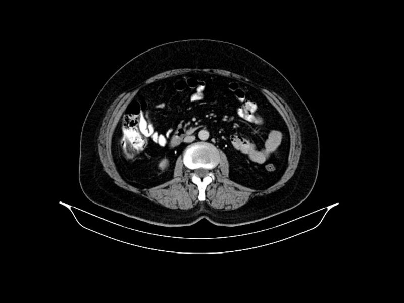 File:Adenocarcinoma of pancreas with hepatic metastasis (Radiopaedia 64332-73122 Axial C+ delayed 52).jpg