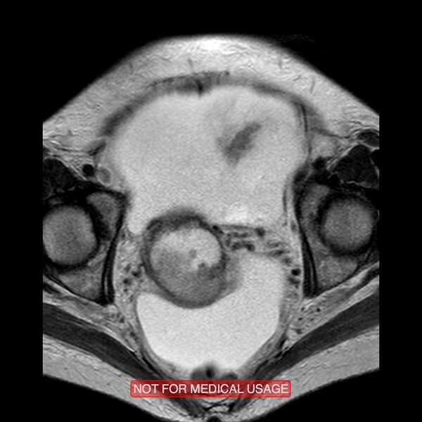 File:Adenocarcinoma of the cervix (Radiopaedia 28373-28615 Axial T2 9).jpg