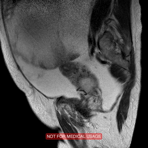 File:Adenocarcinoma of the cervix (Radiopaedia 28373-28615 Sagittal T2 13).jpg
