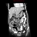 Adenocarcinoma of the colon (Radiopaedia 8191-9039 Coronal liver window 14).jpg