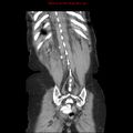 Adenocarcinoma of the colon (Radiopaedia 8191-9039 Coronal liver window 41).jpg