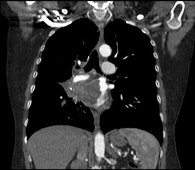 File:Adenocarcinoma of the lung (Radiopaedia 44205-47803 Coronal C+ portal venous phase 49).jpg