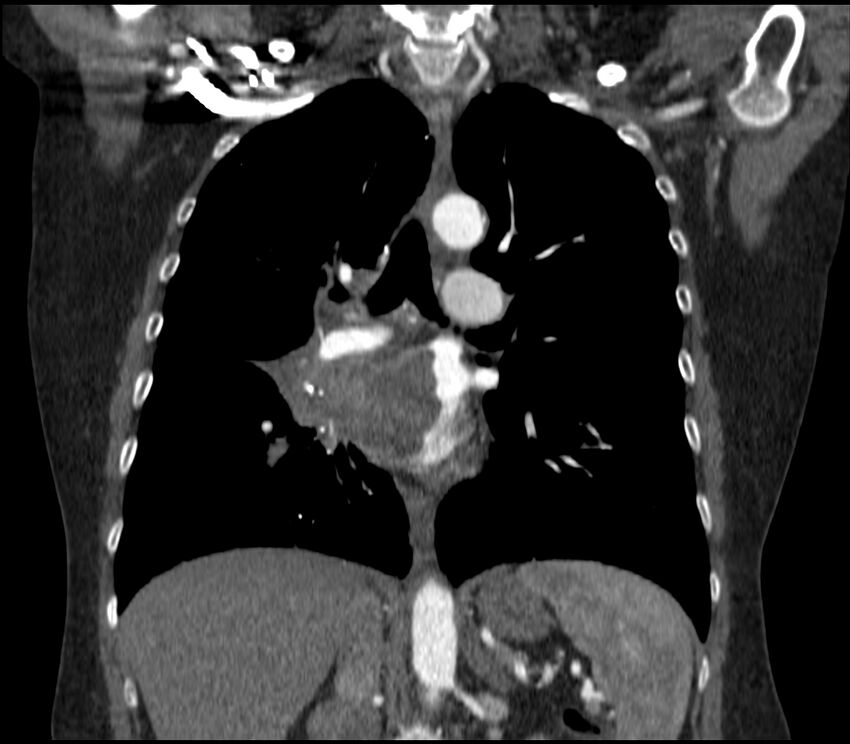 Adenocarcinoma of the lung (Radiopaedia 44205-47803 Coronal C+ portal venous phase 49).jpg