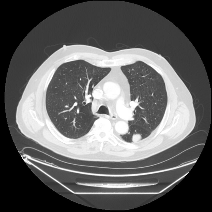 Adenocarcinoma of the lung (Radiopaedia 44876-48759 Axial lung window 30).jpg