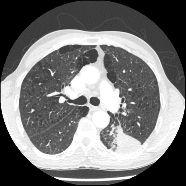 File:Adenocarcinoma of the lung - micropapillary predominant (Radiopaedia 42446-45563 C 21).jpg