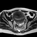 Adenomyoma of the uterus (huge) (Radiopaedia 9870-10438 Axial T2 28).jpg