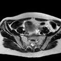 Adenomyoma of the uterus (huge) (Radiopaedia 9870-10438 Axial T2 32).jpg