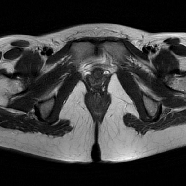 File:Adenomyosis within a septate uterus (Radiopaedia 69963-79981 Axial T2 29).jpg