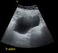 Adnexal multilocular cyst (O-RADS US 3- O-RADS MRI 3) (Radiopaedia 87426-103755 Longitudinal 1).jpg
