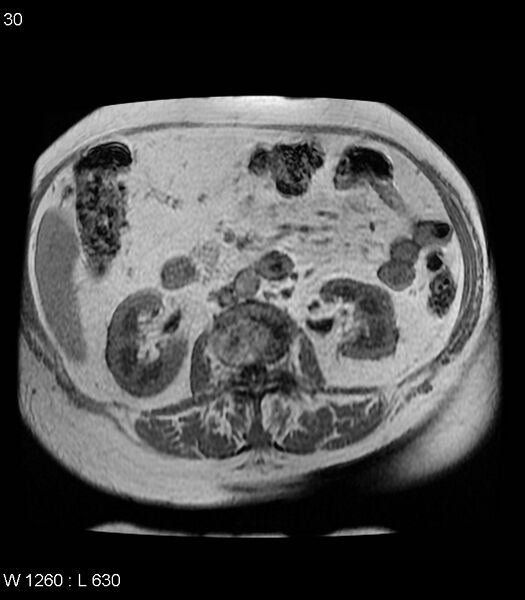File:Adrenal myelolipoma (Radiopaedia 6765-7961 Axial T1 in-phase 30).jpg