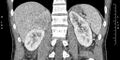 Adrenal pheochromocytoma (Radiopaedia 35133-36726 Coronal C+ portal venous phase 20).jpg
