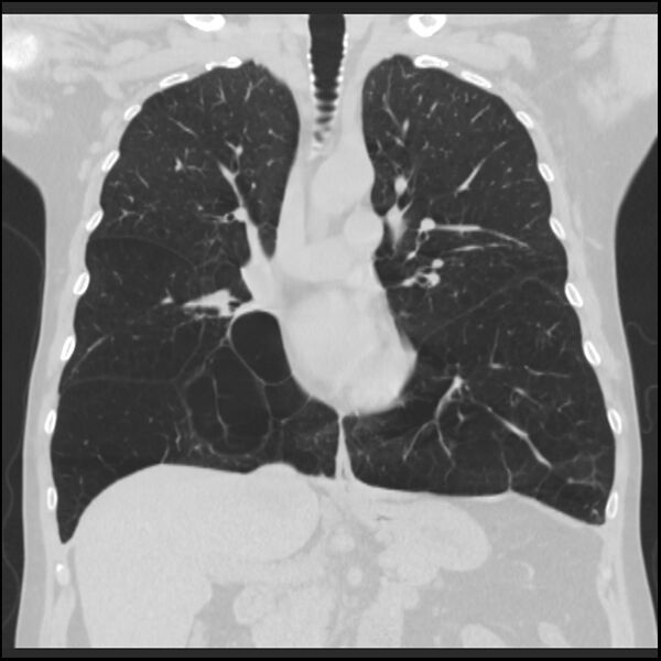 File:Alpha-1-antitrypsin deficiency (Radiopaedia 40993-43722 Coronal lung window 46).jpg