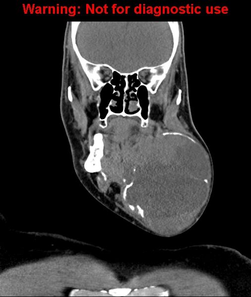 File:Ameloblastoma (Radiopaedia 33126-34164 D 28).jpg