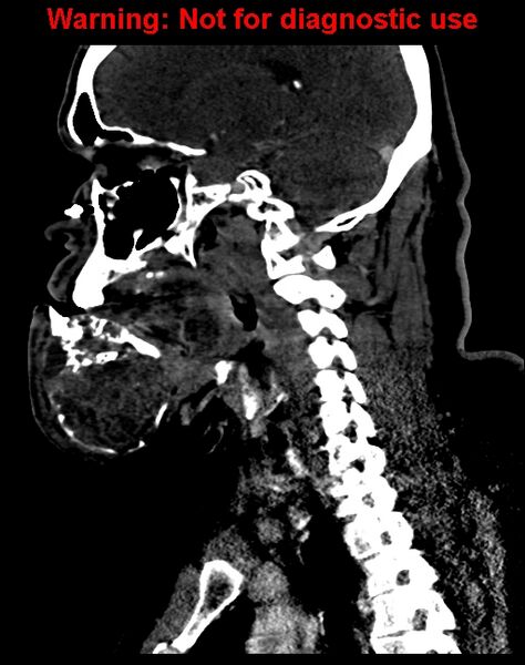 File:Ameloblastoma (Radiopaedia 33126-34164 F 42).jpg