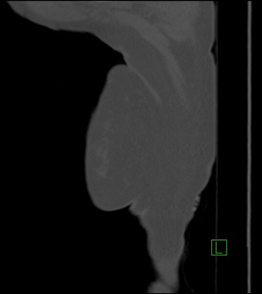 File:Amiodarone deposition in the liver (Radiopaedia 77587-89780 Sagittal bone window 100).jpg