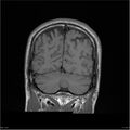 Amnestic syndrome secondary to hypoxic brain injury (Radiopaedia 24743-25004 B 6).jpg