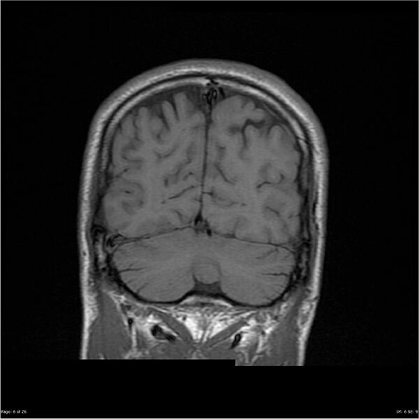 File:Amnestic syndrome secondary to hypoxic brain injury (Radiopaedia 24743-25004 B 6).jpg