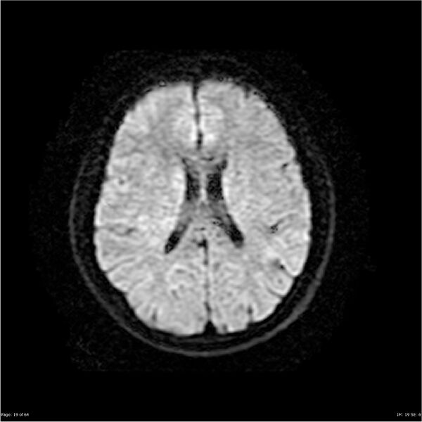 File:Amnestic syndrome secondary to hypoxic brain injury (Radiopaedia 24743-25004 DWI 19).jpg