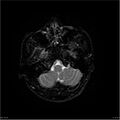 Amnestic syndrome secondary to hypoxic brain injury (Radiopaedia 24743-25004 DWI 38).jpg
