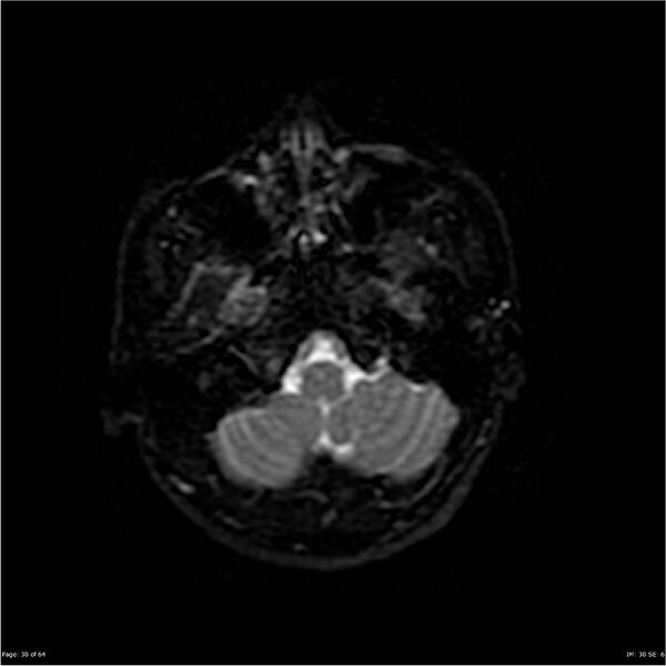 File:Amnestic syndrome secondary to hypoxic brain injury (Radiopaedia 24743-25004 DWI 38).jpg
