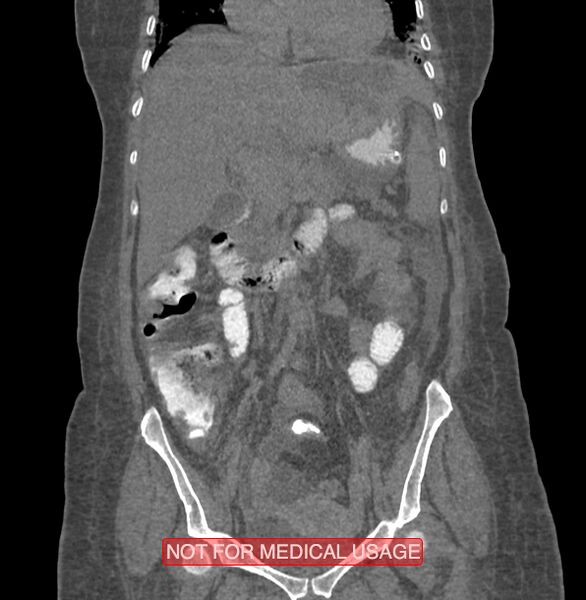 File:Amoebic enterocolitis with liver abscess (Radiopaedia 35100-36609 B 85).jpg