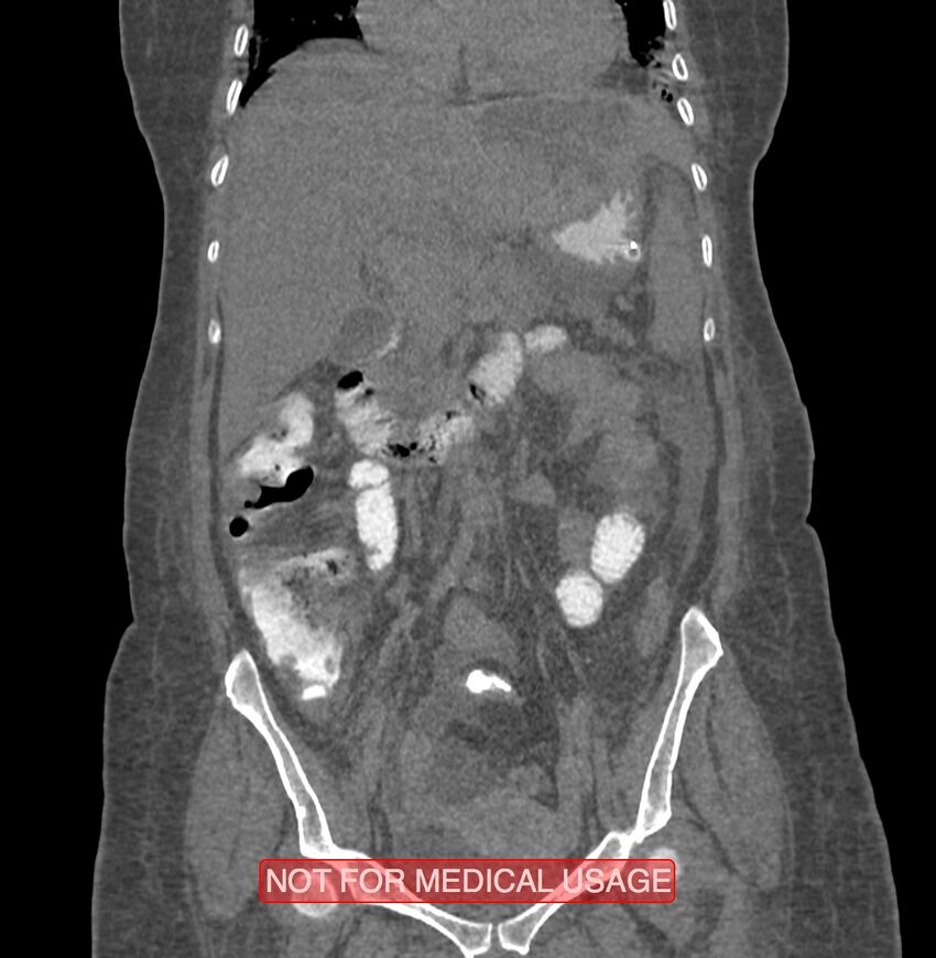 Amoebic enterocolitis with liver abscess (Radiopaedia 35100-36609 B 85).jpg