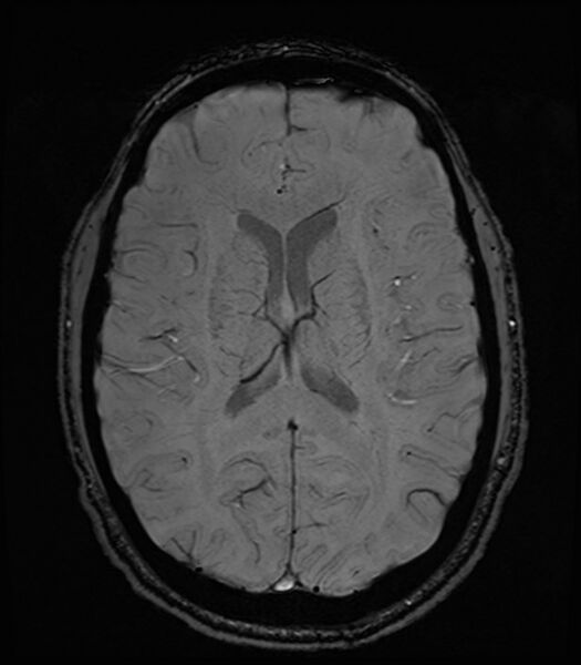File:Amyotrophic lateral sclerosis (Radiopaedia 87352-103658 Axial SWI 34).jpg