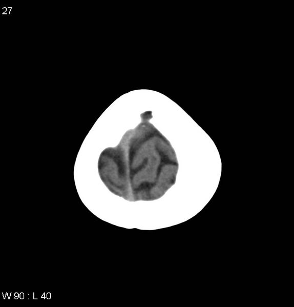 File:Anaplastic astrocytoma NOS (Radiopaedia 40188-42698 Axial non-contrast 27).jpg