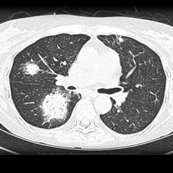 CT scan lungs: multiple lung lesions with ground-glass opacity suggesting haemorrhage