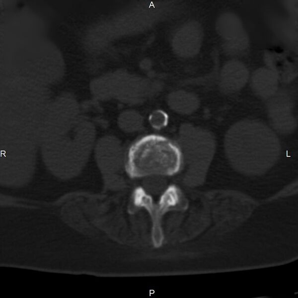File:Ankylosing spondylitis (Radiopaedia 8748-9556 Axial bone window 30).jpg