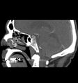 Anterior cerebral artery trifurcation (Radiopaedia 59107).jpg