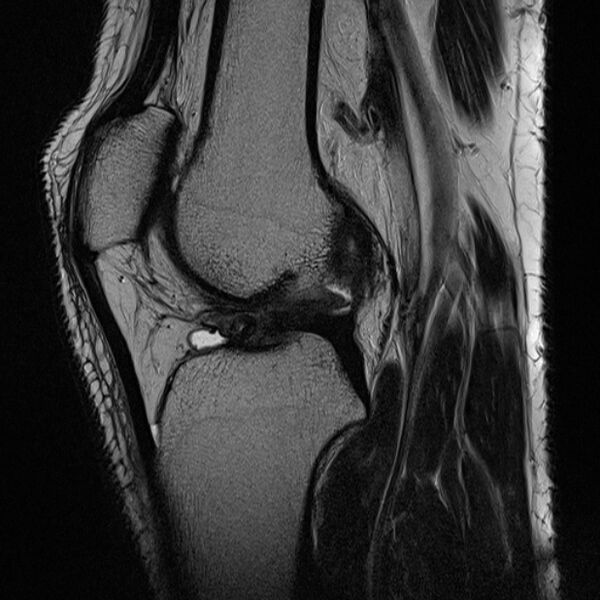 File:Anterior cruciate ligament tear - ramp lesion (Radiopaedia 71883-82322 Sagittal T2 12).jpg