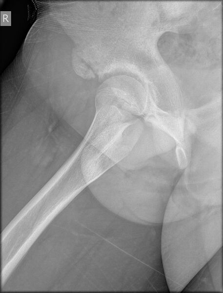 File:Anterior inferior iliac spine avulsion fracture (Radiopaedia 61170-69063 Oblique 1).jpg