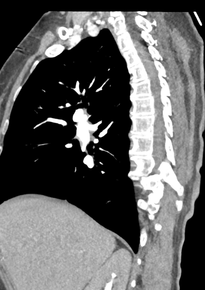 File:Aortic dissection - Stanford type B (Radiopaedia 50171-55512 C 45).png
