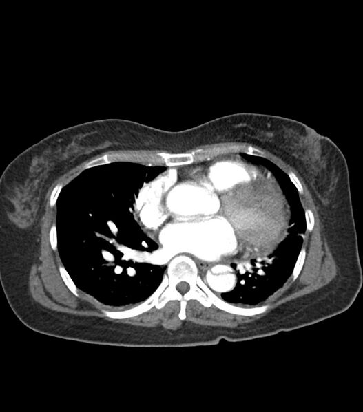 File:Aortic dissection with renal ischemia (Radiopaedia 76573-88338 A 41).jpg