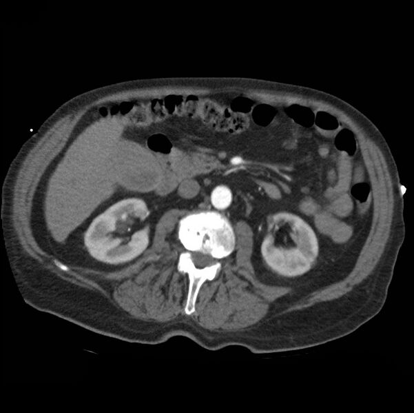 File:Aortic dissection with rupture into pericardium (Radiopaedia 12384-12647 A 63).jpg
