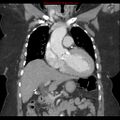 Aortic valve stenosis (Radiopaedia 14480-14423 A 7).jpg
