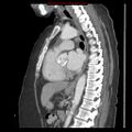 Aortic valve stenosis (Radiopaedia 14480-14423 B 4).jpg