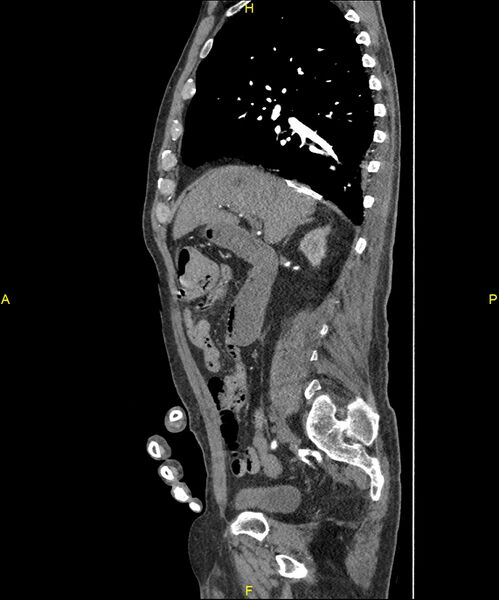 File:Aortoenteric fistula (Radiopaedia 84308-99603 C 130).jpg