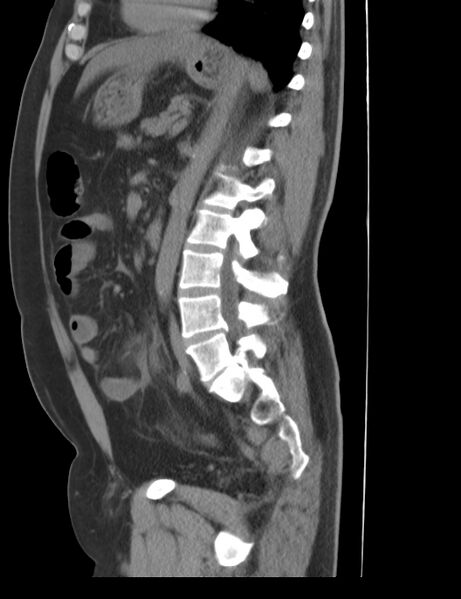 File:Appendicitis and giant appendicolith (Radiopaedia 80251-93588 C 22).jpg