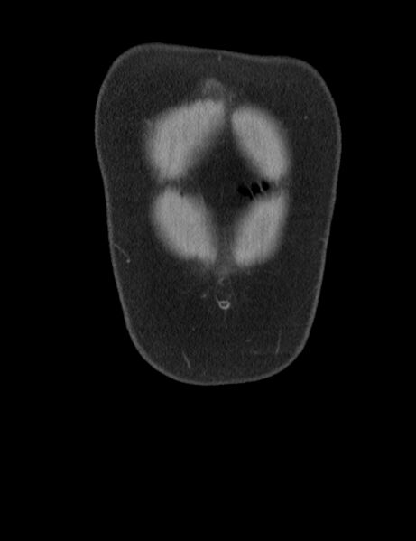 File:Appendicitis and giant appendicolith (Radiopaedia 80251-93588 Coronal non-contrast 1).jpg
