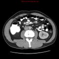 Appendicitis and renal cell carcinoma (Radiopaedia 17063-16760 A 30).jpg