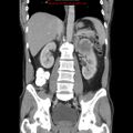 Appendicitis and renal cell carcinoma (Radiopaedia 17063-16760 B 19).jpg