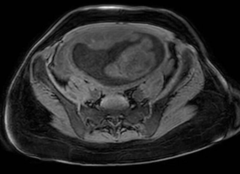 File:Appendicitis in gravida (MRI) (Radiopaedia 89433-106395 Axial DIXON 106).jpg