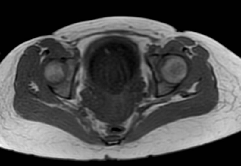 File:Appendicitis in gravida (MRI) (Radiopaedia 89433-106395 Axial T1 in-phase 64).jpg