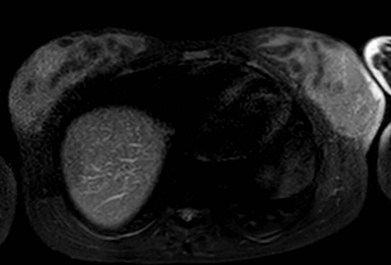 File:Appendicitis in gravida (MRI) (Radiopaedia 89433-106395 Axial T2 SPAIR 4).jpg