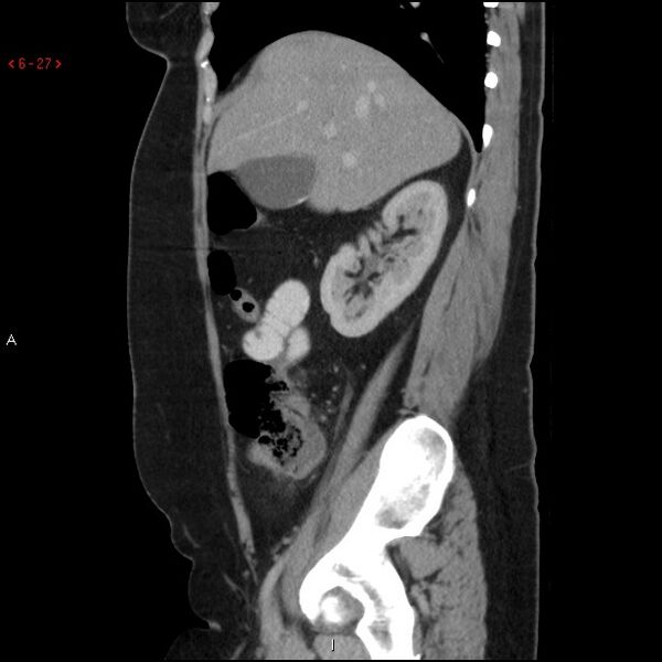 File:Appendicitis with microperforation- promontoric type (Radiopaedia 27268-27442 A 12).jpg